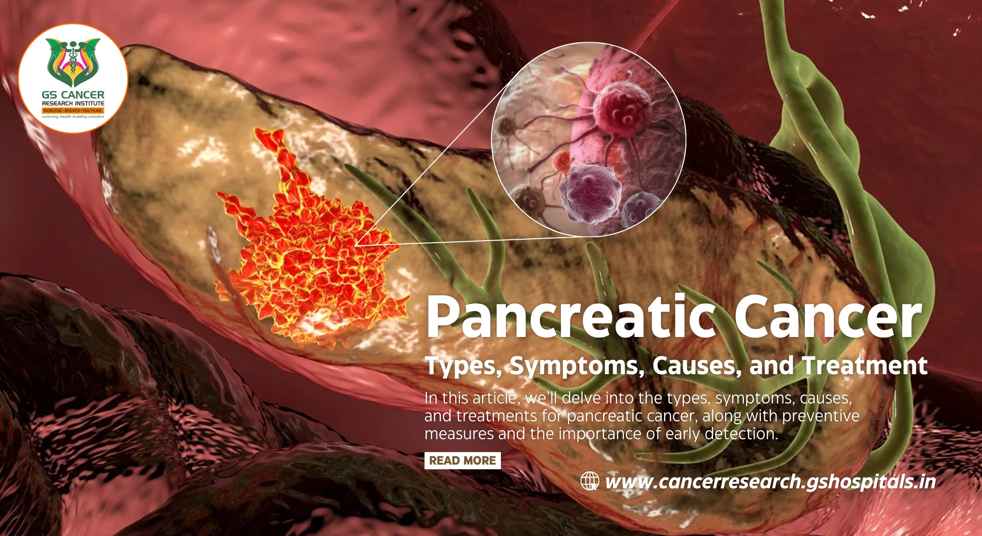 Pancreatic Cancer: Types, Symptoms, Causes, and Treatment