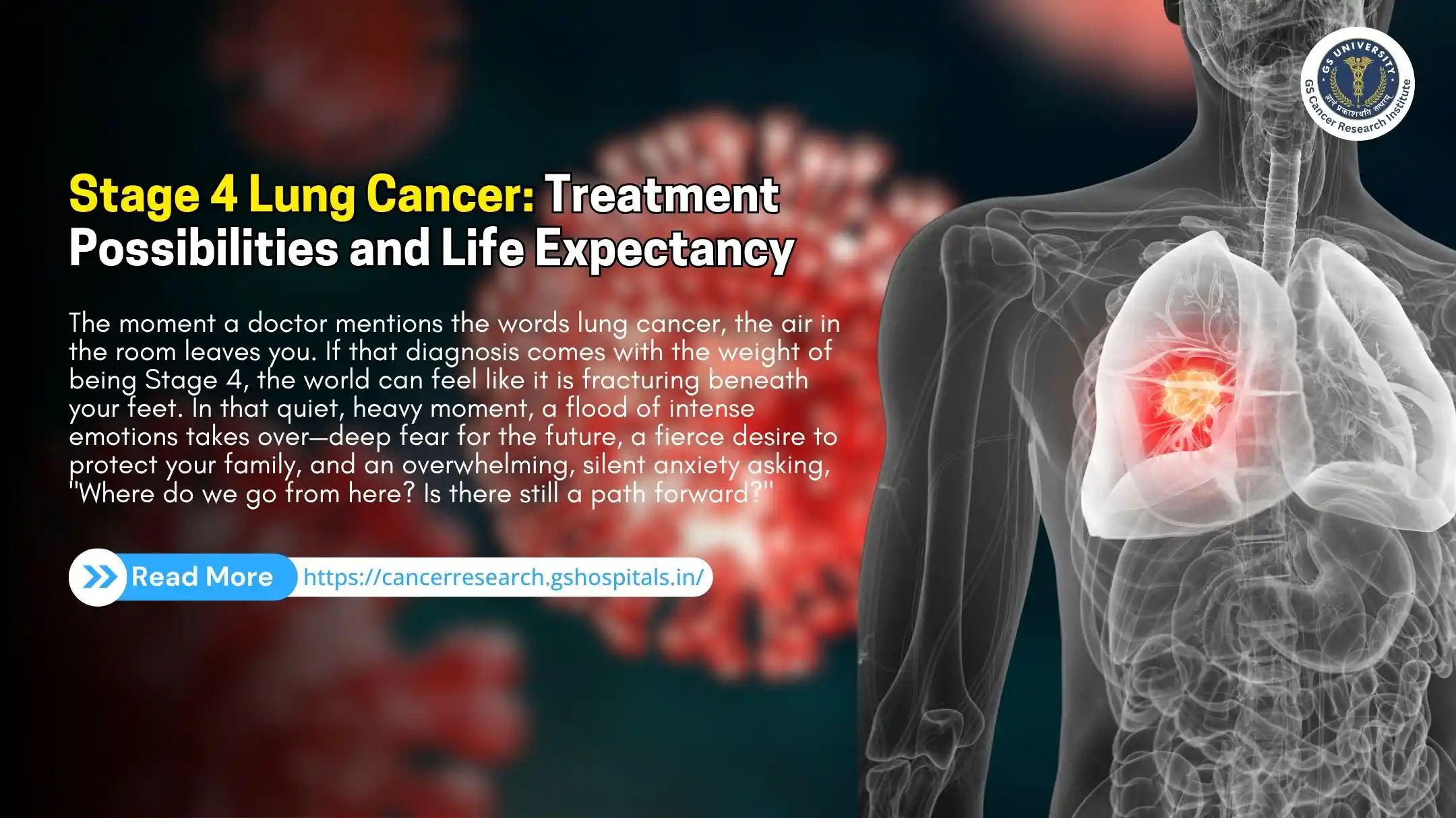 Stage 4 Lung Cancer: Treatment Possibilities and Life Expectancy